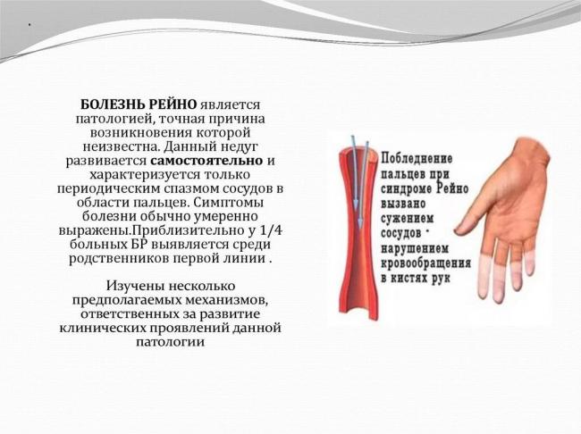 Синдром м. рейно: причины, симптомы, диагностика и лечение