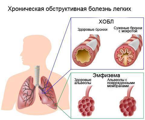 Хобл: классификация по степени тяжести, этиология, патогенез, диагностика, лечение, 2, 4, как долго можно прожить