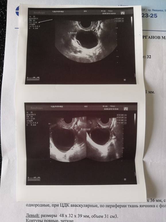 Эндометрий - endometrium