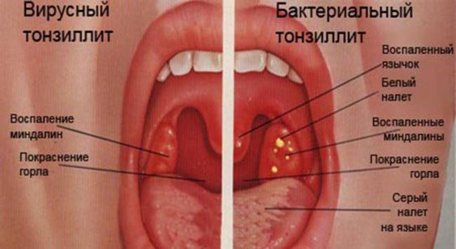 Бактериальный тонзиллит: лечение, симптомы, осложнения