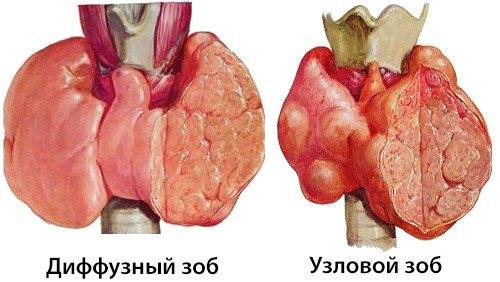 Диффузный (эндемический) зоб