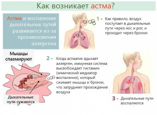 Астма: причины, признаки и симптомы у взрослых, лечение