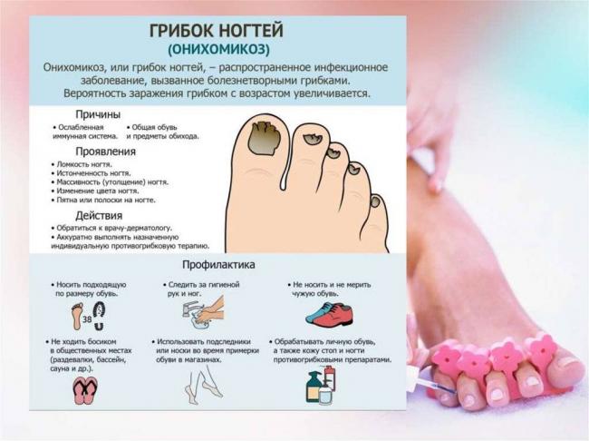 Онихомикоз: причины, симптомы, диагностика, лечение