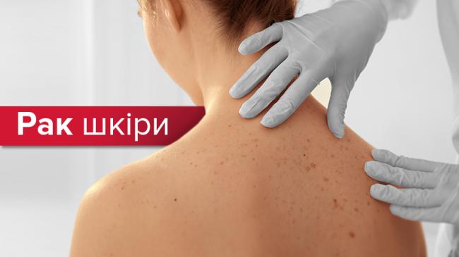 Как выглядит начальная стадия меланомы кожи: фото разных видов