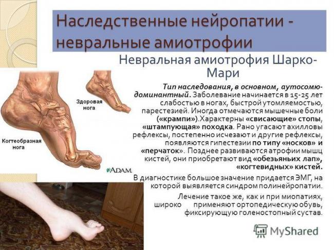 Невральная амиотрофия шарко–мари–тута