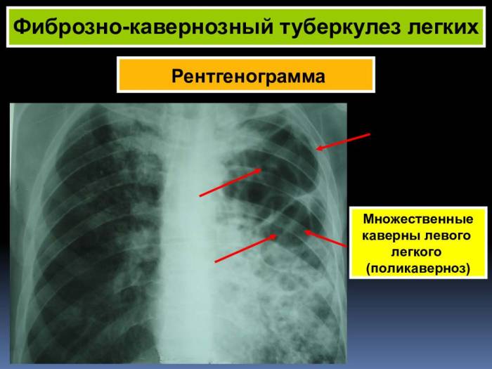 Кавернозный туберкулез легких