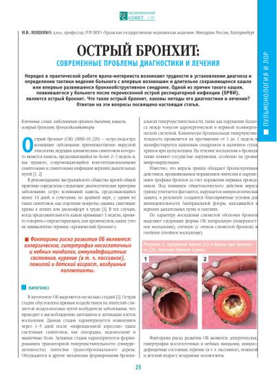 Чем лечить бронхит и вызванный им кашель у взрослого?