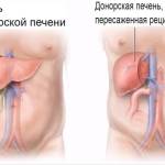 Сколько живут после трансплантации печени при циррозе?