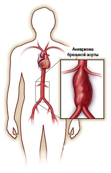 Аневризма брюшной аорты. симптомы, узи, признаки, диагностика, лечение без операции