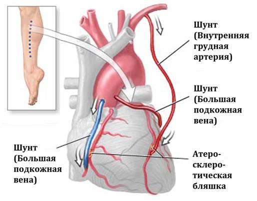 Сколько и как живут люди после шунтирования сосудов сердца