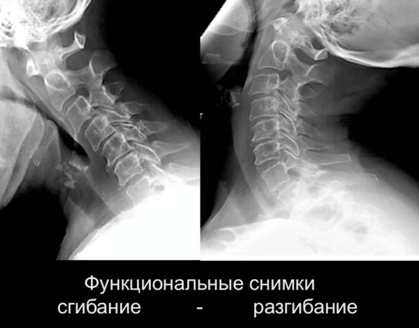 Нестабильность поясничного отдела позвоночника симптомы лечение