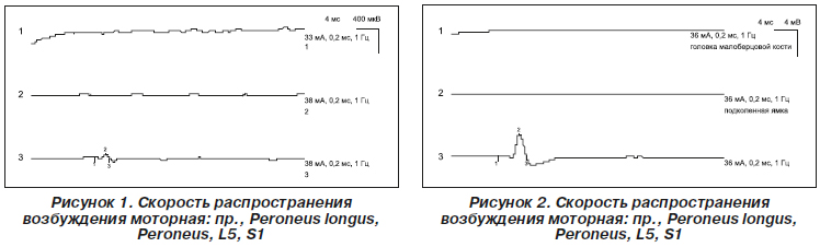 Как лечить нейропатию малоберцового нерва