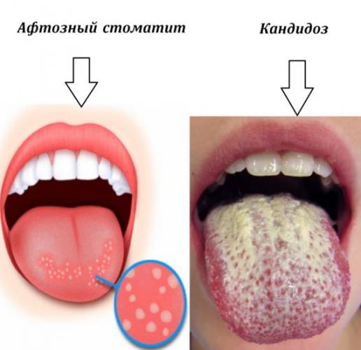 Гормональные уколы при астме