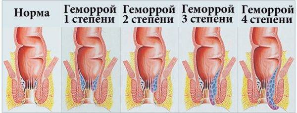 Противогеморроидальное средство Гепатромбин Г - отзывы