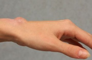 Что такое гигрома на запястье руки, почему возникает, как лечить