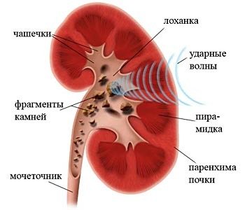 Как избавиться от камней в почках