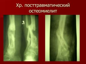 Артериовенозная фистула