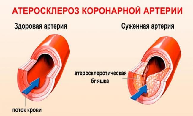 Тиоктовая кислота: показания к применению