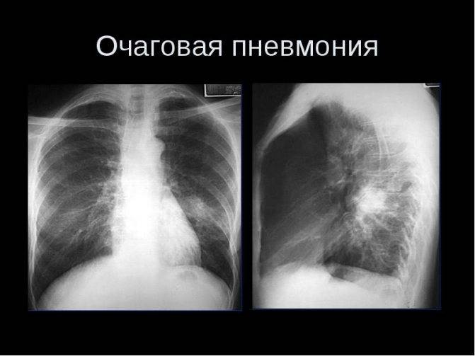 Правосторонняя пневмония у ребенка: причины, симптомы и лечение
