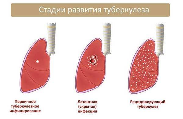 Температура при туберкулезе