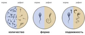 Варикоцеле, спермограмма