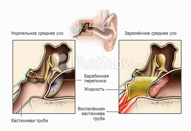 Тубоотит (евстахиит) - симптомы болезни, профилактика и лечение тубоотита (евстахиита), причины заболевания и его диагностика на eurolab