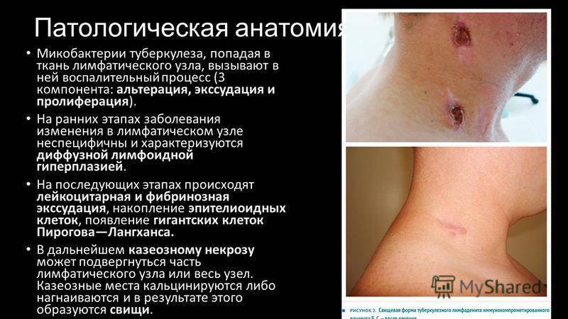 Туберкулез лимфоузлов у детей: симптоматика и принцип лечения