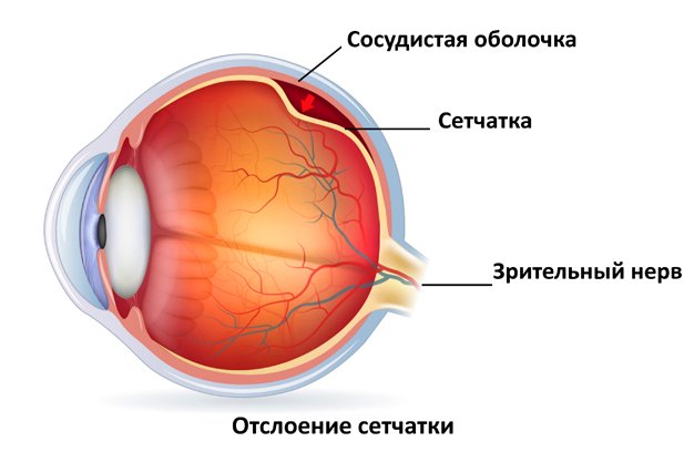 Отслойка сетчатки глаза: операция и лечение лазером при отслоение сетчатки глаза