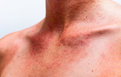 Иммуноглобулин человека против клещевого энцефалита (immunoglobulin human against encephalitis ixodicum)