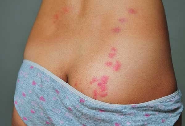 Что сделать, чтобы клопы не кусали