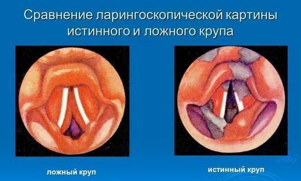 Первая помощь при ложном крупе. (Ларингоспазме)