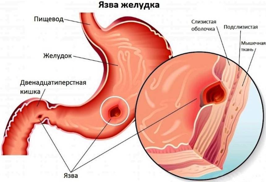 Табакокурение и активный туберкулез: влияние и лечение