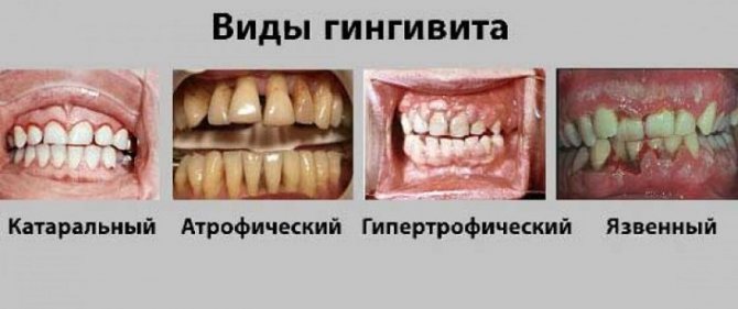 Кровоточивость десен