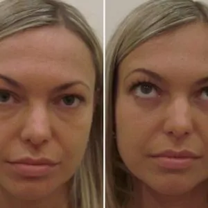 Грыжи под глазами: лечение и профилактика, удаление