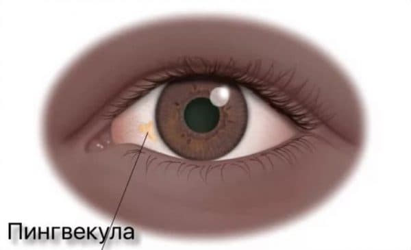 Пингвекула глаза народные средства