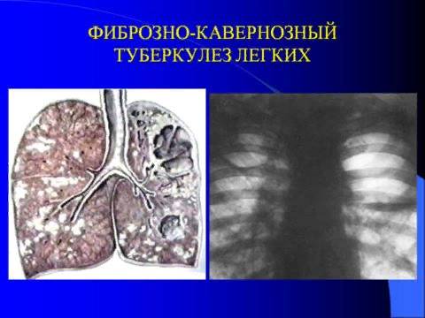 Какая температура при туберкулезе?