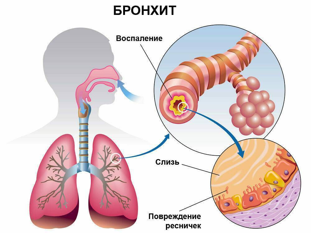 Острый бронхит: симптомы, лечение и профилактика у взрослых