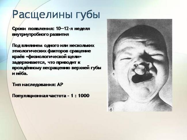 Что такое волчья пасть: фото, виды, причины возникновения, методы терапии
