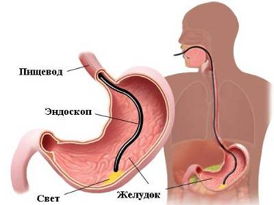 Хронический холецистопанкреатит симптомы