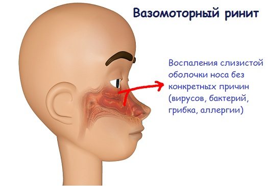 Лечение вазомоторного ринита: как лечить у взрослых в домашних условиях
