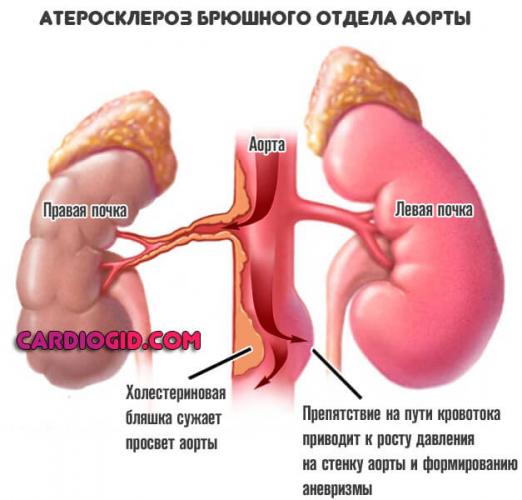 Аневризма брюшной аорты: причины заболевания, основные симптомы, лечение и профилактика