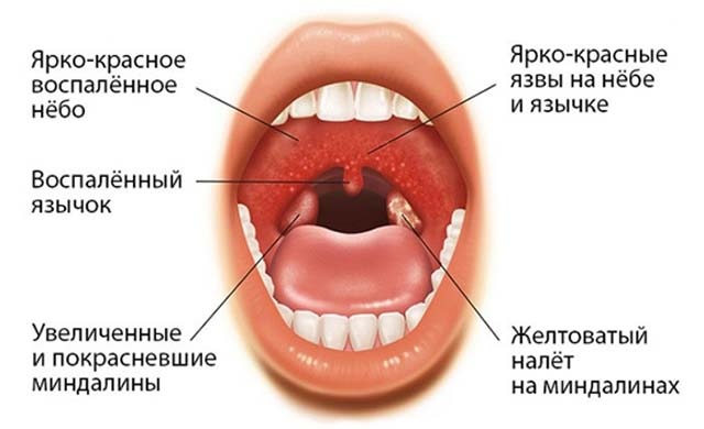 Паратонзиллярный абсцесс ангина