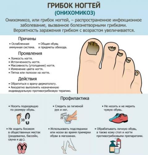 Грибок ногтей (онихомикоз)