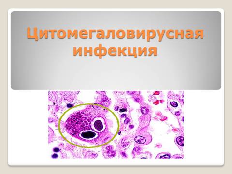 Симптомы цитомегаловирусной инфекции — особенности течения цмв-инфекции при разных формах