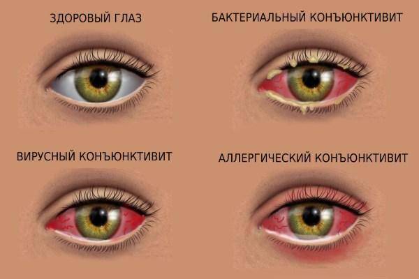 Покраснение глаз