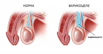 Варикоцеле у мужчин