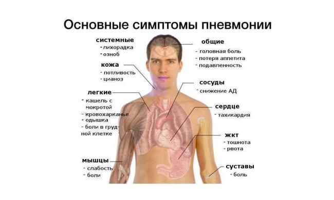 Признаки пневмонии у взрослого с температурой – симптомы воспаления легких
