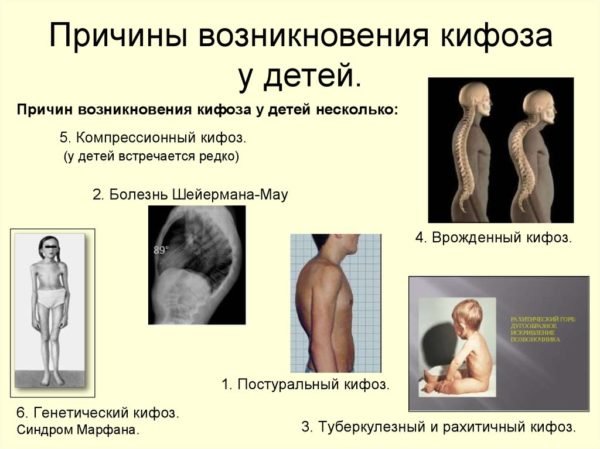 Что такое сколиоз у детей и как его вылечить?
