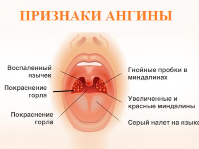 Лечение бактериальной ангины у взрослых и детей, ее причины и симптомы