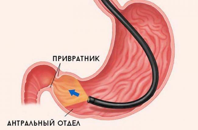 Недостаточно кардии желудка народное лечение